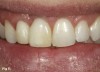 Fig 11. The smile of the patient in provisional restorations tooth No. 7 and implant No. 8 after correction and healing of the periodontium.
