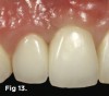 Fig 13. The veneered zirconia framework of splinted crowns on tooth No. 7 and implant No. 8 was cemented with provisional cement and maintained. The interdental papilla is still slightly shorter (more apical) than the papilla adjacent to tooth No. 9, and the papilla distal to tooth No. 7 is slightly longer after orthodontic correction.