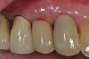 Fig 1. Clinical view of the maxillary right first premolar implant in a healthy 63-year-old woman. The swelling in the tissue surrounding the first premolar implant bled on probing and was associated with peri-implant mucositis. The lesion developed 4 years after implant placement.