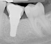 Fig 5. Radiograph of a mandibular right first molar implant in a 31-year-old woman taken 1 year after placement. No bone loss beyond physiologic remodeling has occurred; there is a suggestion of possible cement at the distal.
