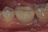 Fig 6. A clinical view of this area suggests that peri-implant mucositis is present. The tissue is swollen, it bleeds on probing, has 5 mm of probing depth, and exhibits purulent exudate.