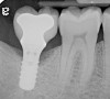 Fig 8. Radiograph taken 3 years after restoration of this mandibular right second molar implant demonstrating a peri-implant lesion.