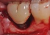 Fig 9. Clinical view of this lesion shows the circumferential pattern to the bone loss.