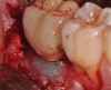 Fig 10. After surface decontamination with both air powder abrasive and citric acid, a regenerative approach was used that includes applying recombinant platelet-derived growth factor-BB to the implant’s surface, a bone replacement graft mixed with biologics, and a hydrogel barrier.