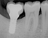 Fig 11. Radiograph taken 1 year after regenerative therapy suggests favorable bone gain covering the entire roughened surface of the dental implant.