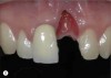 Fig 8 It takes seconds to destroy and sometimes years to reconstruct. This patient had an incorrectly placed implant that created a tremendous defect. Years of surgery and orthodontics were necessary to correct the discrepancy.