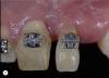Fig 9. It takes seconds to destroy and sometimes years to reconstruct. This patient had an incorrectly placed implant that created a tremendous defect. Years of surgery and orthodontics were necessary to correct the discrepancy.