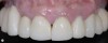 Fig 14 Pretreatment and posttreatment views of the implant-supported reconstruction. Notice the favorable changes in the gingival outline and tooth proportions.