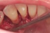 Subgingival calculus and severe bone loss.