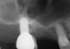 The pretreatment radiograph suggesting more than 2 mm of subantral alveolar bone.